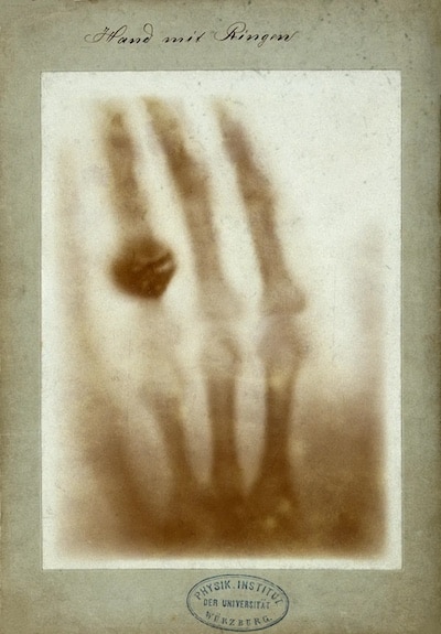 Managing Radiation Therapy Side Effects with Genetic Testing 2 First medical X ray by Wilhelm RA¶ntgen of his wife Anna Bertha Ludwigs hand 18951222 1 copy