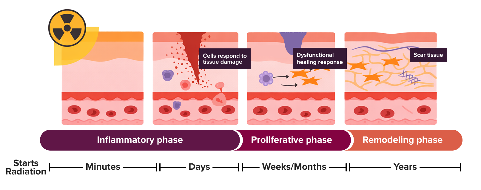 mk breast cancer rad blog fibrosis